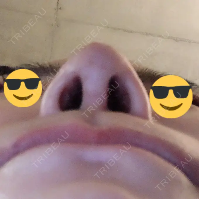 隆鼻術 / 軟骨移植 / 骨切幅寄せ / 鼻尖縮小 / その他（鼻） 韓国BBクリニック（旧 シンミアン形成外科） DAY 88 メイン用