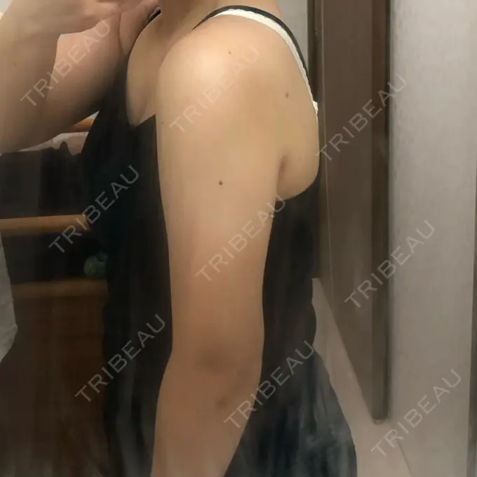 脂肪吸引（二の腕） 湘南美容クリニック 岡山院 DAY 61 メイン用