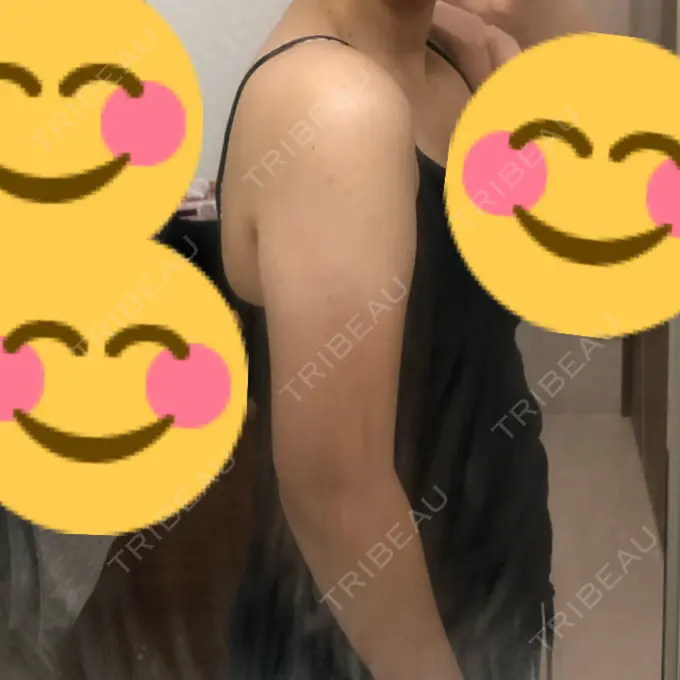 脂肪吸引（二の腕） 湘南美容クリニック 岡山院 DAY 61 メイン用