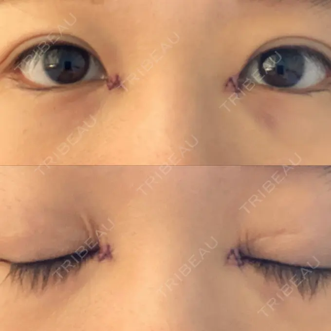 蒙古ひだ形成 / 目元修正 銀座高須クリニック DAY 3 メイン用