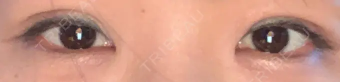 二重埋没 湘南美容クリニック 京都院 AFTER メイン用