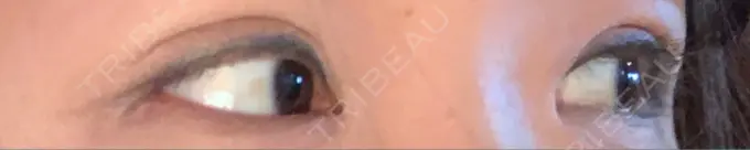 二重埋没 湘南美容クリニック 京都院 DAY 31 メイン用