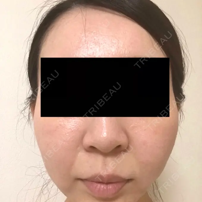 脂肪吸引（顔） GRACIA clinic 【グラシアクリニック】 AFTER メイン用