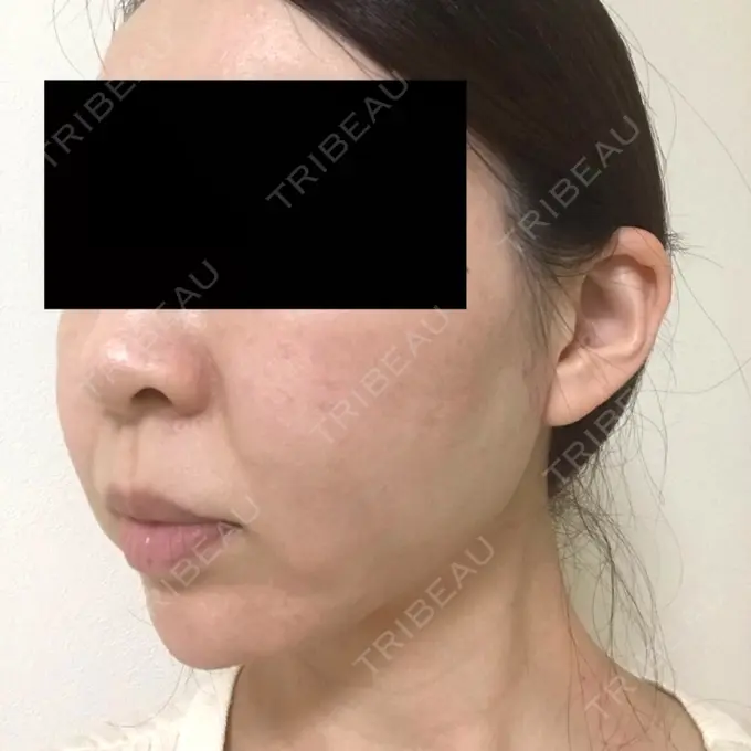 脂肪吸引（顔） GRACIA clinic 【グラシアクリニック】 DAY 21 メイン用