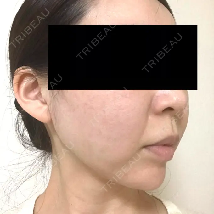 脂肪吸引（顔） GRACIA clinic 【グラシアクリニック】 DAY 21 メイン用