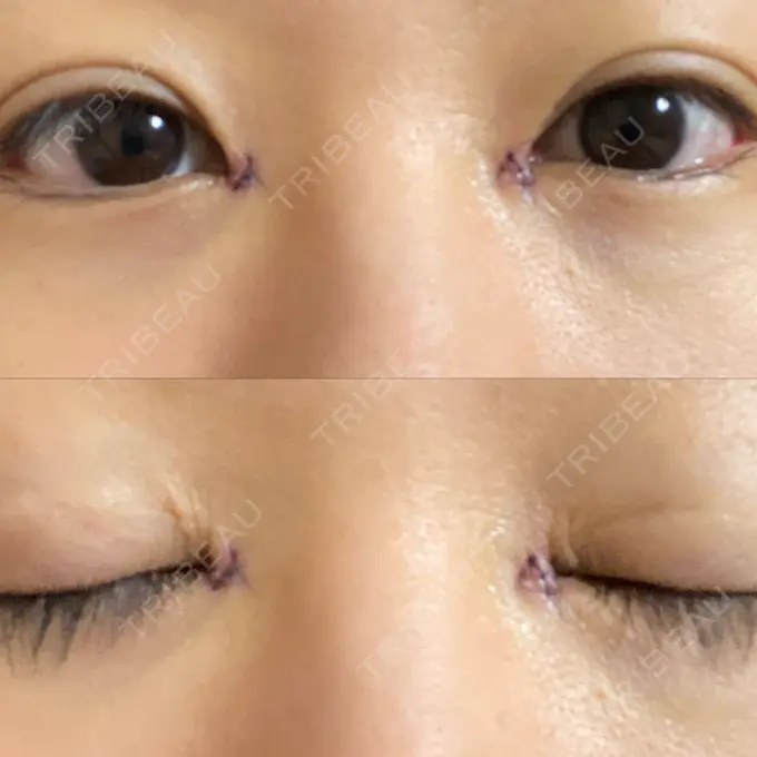 蒙古ひだ形成 / 目元修正 銀座高須クリニック DAY 4 メイン用