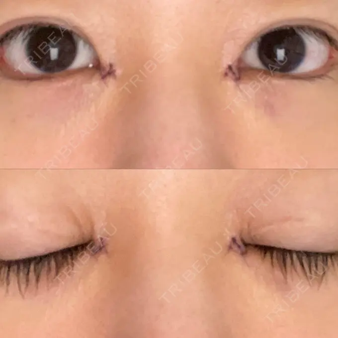 蒙古ひだ形成 / 目元修正 銀座高須クリニック DAY 5 メイン用