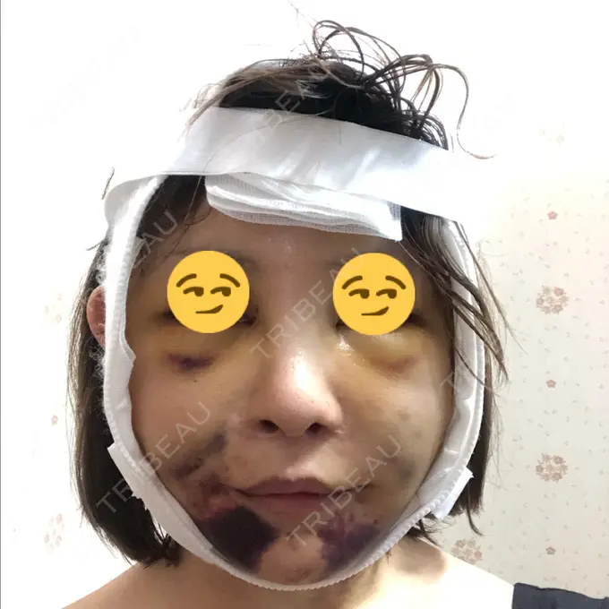 あごプロテーゼ / 前額リフト / 切開リフト THE PLAN（ザ・プラン）美容整形外科・皮膚科 DAY 6 メイン用