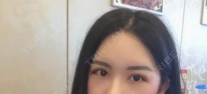 二重切開 / 目頭切開 / 目尻切開 / その他（目元） DI（ディアイ）整形外科 DAY 7 メイン用