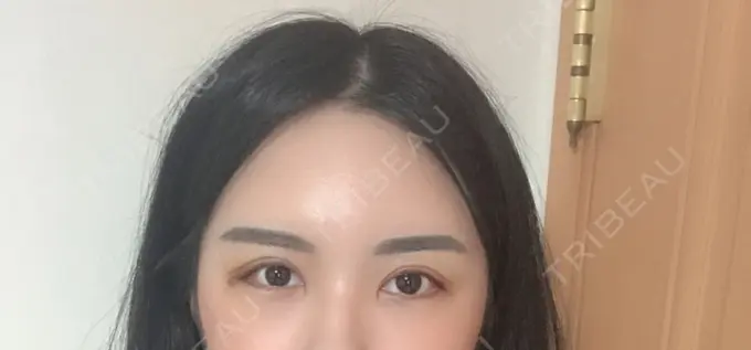 二重切開 / 目頭切開 / 目尻切開 / その他（目元） DI（ディアイ）整形外科 DAY 7 メイン用