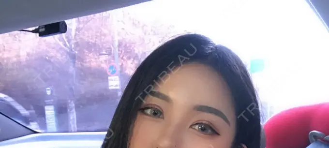 二重切開 / 目頭切開 / 目尻切開 / その他（目元） DI（ディアイ）整形外科 AFTER メイン用