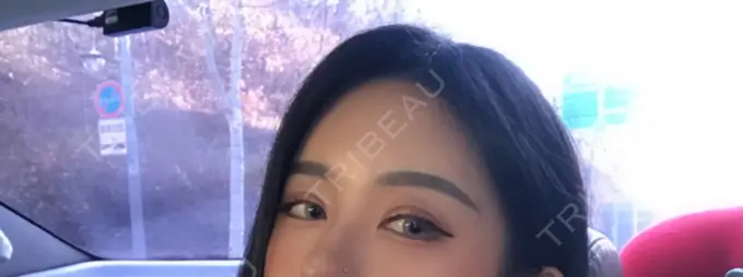 二重切開 / 目頭切開 / 目尻切開 / その他（目元） DI（ディアイ）整形外科 DAY 14 メイン用