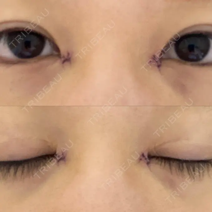 蒙古ひだ形成 / 目元修正 銀座高須クリニック DAY 6 メイン用