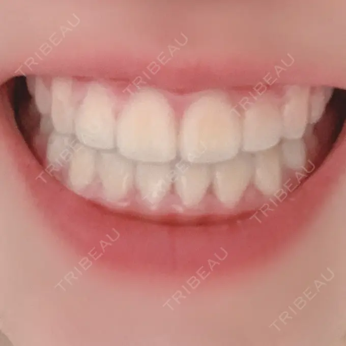 矯正（ワイヤー） ランバート矯正歯科 DAY 593 メイン用