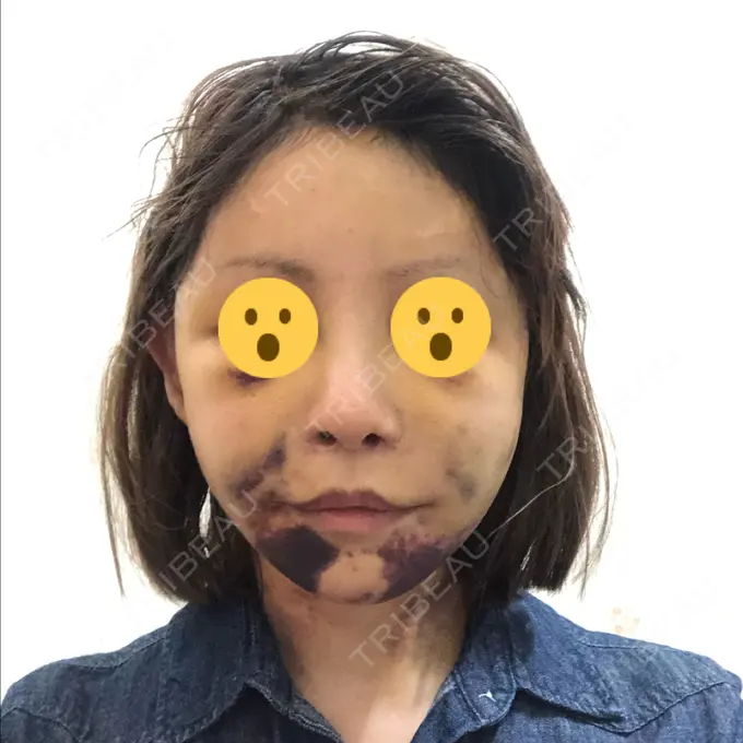 あごプロテーゼ / 前額リフト / 切開リフト THE PLAN（ザ・プラン）美容整形外科・皮膚科 DAY 7 メイン用