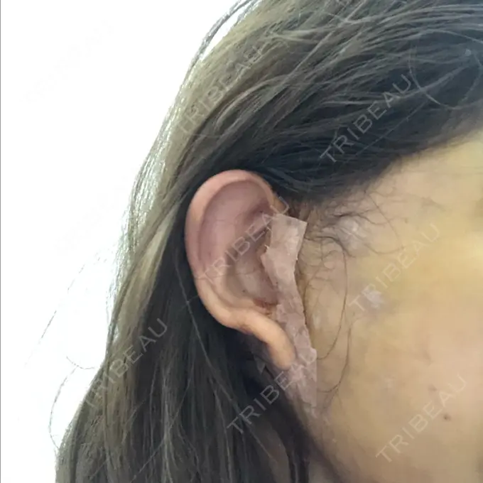 あごプロテーゼ / 前額リフト / 切開リフト THE PLAN（ザ・プラン）美容整形外科・皮膚科 DAY 7 メイン用