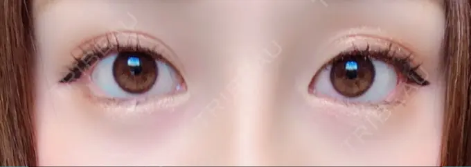 タレ目形成・グラマラスライン（切開） / その他（目元） グローバルビューティークリニック 大阪院 DAY 0 メイン用