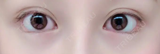 タレ目形成・グラマラスライン（切開） / その他（目元） グローバルビューティークリニック 大阪院 DAY 0 メイン用