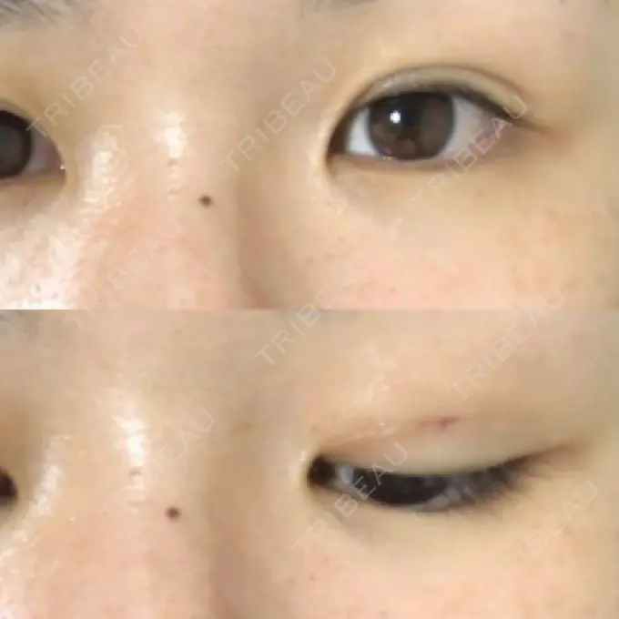 二重埋没 城本クリニック 名古屋院 DAY 3 メイン用