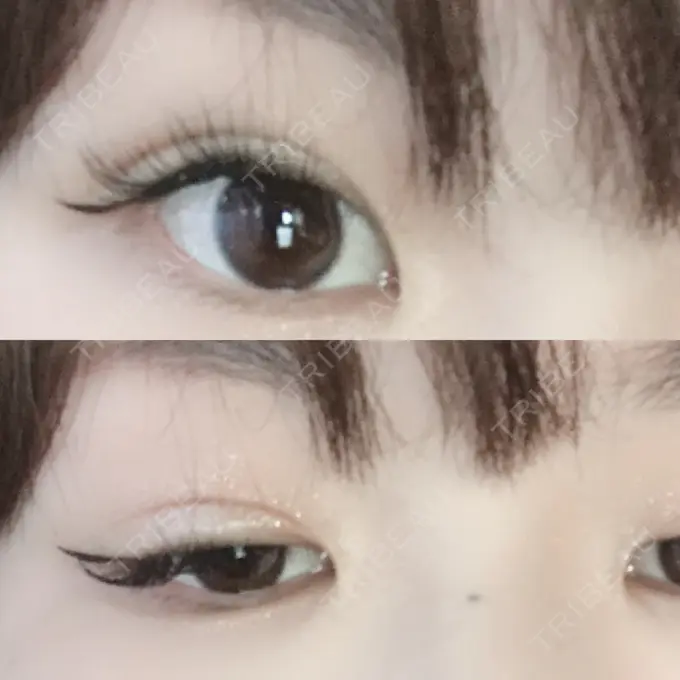 二重埋没 城本クリニック 名古屋院 DAY 8 メイン用