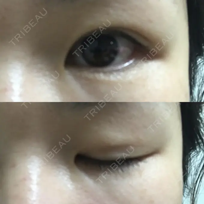 二重埋没 城本クリニック 名古屋院 DAY 68 メイン用