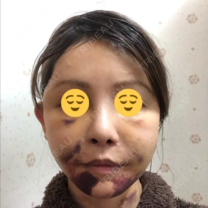 あごプロテーゼ / 前額リフト / 切開リフト THE PLAN（ザ・プラン）美容整形外科・皮膚科 DAY 8 メイン用