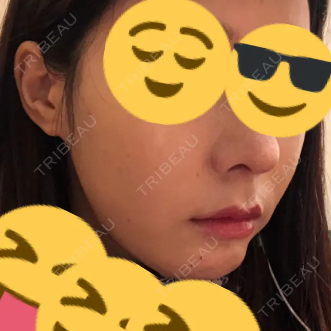 ルフォー+ssro（両あご) / 輪郭修正 ウォンジン（Wonjin）整形外科 AFTER メイン用