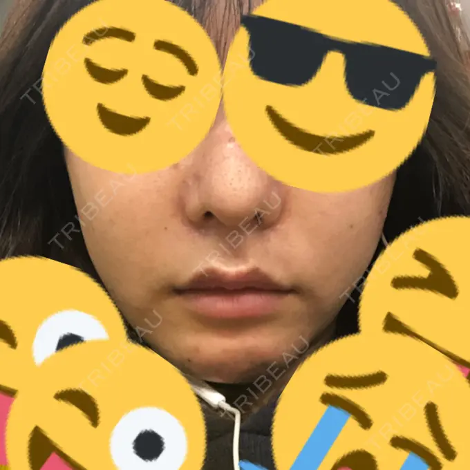 ルフォー+ssro（両あご) / 輪郭修正 ウォンジン（Wonjin）整形外科 DAY 98 メイン用