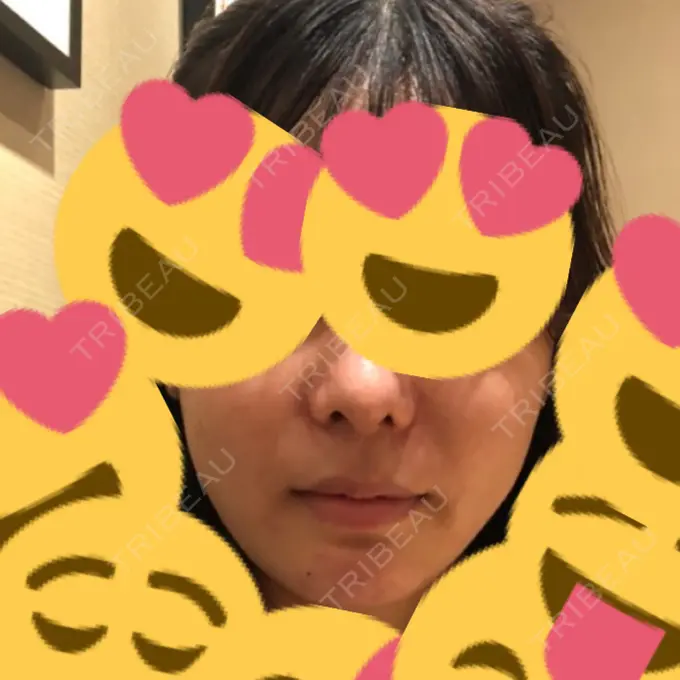 ルフォー+ssro（両あご) / 輪郭修正 ウォンジン（Wonjin）整形外科 DAY 61 メイン用