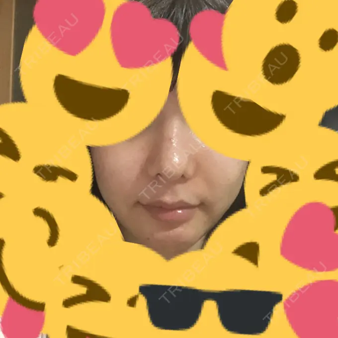 ルフォー+ssro（両あご) / 輪郭修正 ウォンジン（Wonjin）整形外科 DAY 102 メイン用