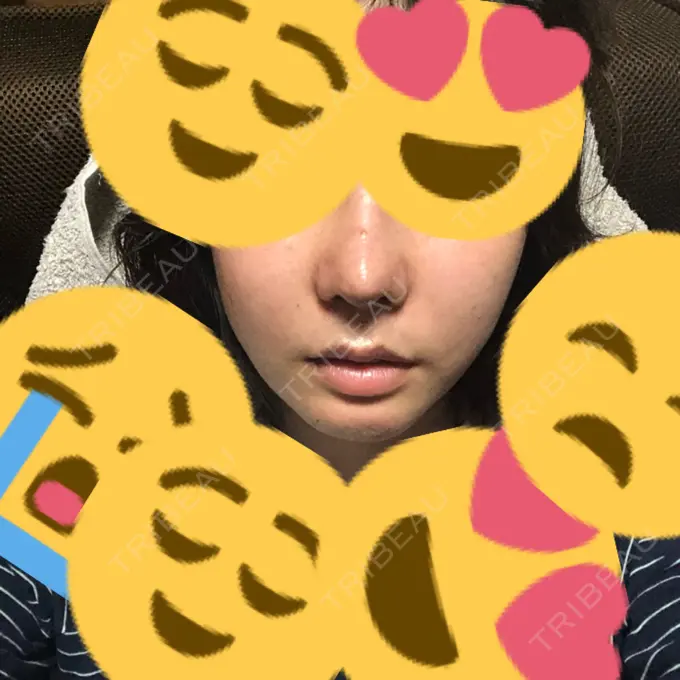 ルフォー+ssro（両あご) / 輪郭修正 ウォンジン（Wonjin）整形外科 DAY 43 メイン用