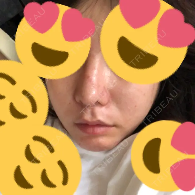 ルフォー+ssro（両あご) / 輪郭修正 ウォンジン（Wonjin）整形外科 DAY 67 メイン用