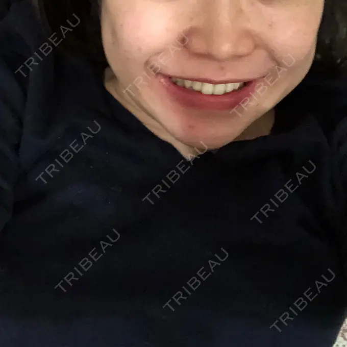 二重埋没 / 目頭切開 / ルフォー+ssro（両あご) / 輪郭修正 View美容整形外科 AFTER メイン用