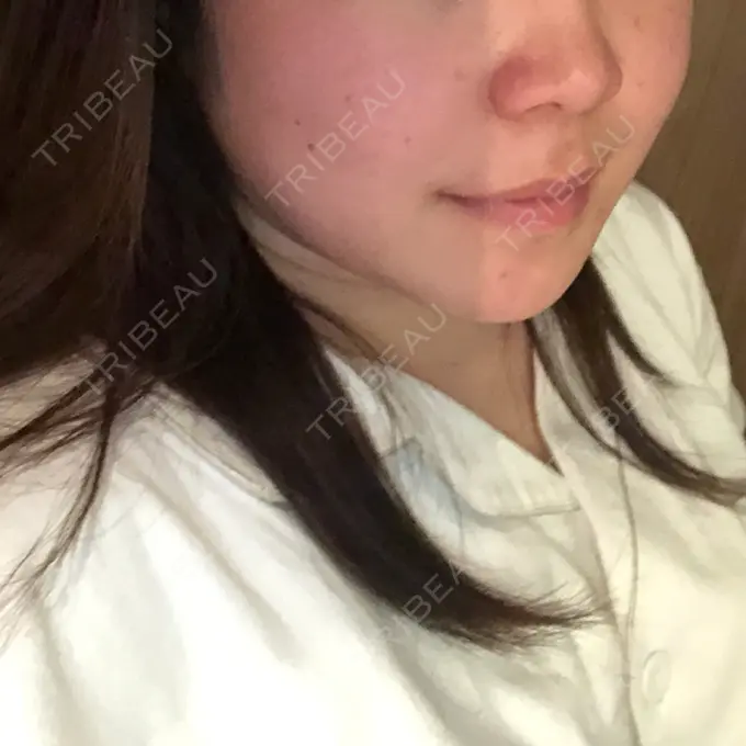 二重埋没 / 目頭切開 / ルフォー+ssro（両あご) / 輪郭修正 View美容整形外科 DAY 183 メイン用