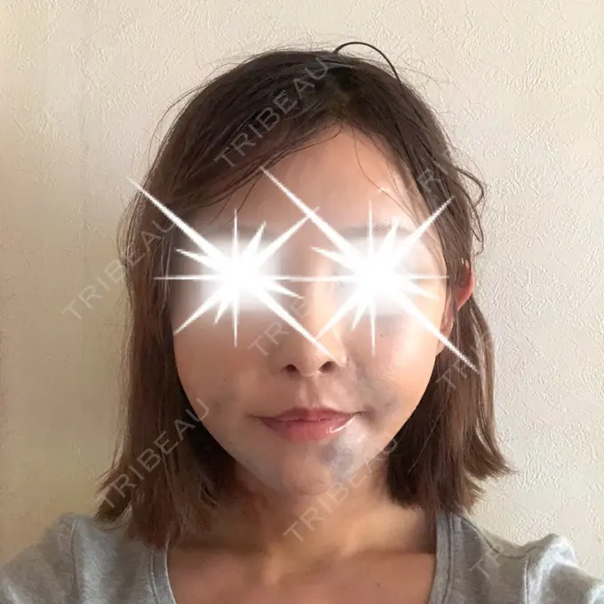 あごプロテーゼ / 前額リフト / 切開リフト THE PLAN（ザ・プラン）美容整形外科・皮膚科 DAY 11 メイン用