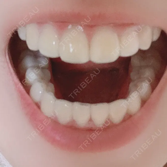 矯正（ワイヤー） ランバート矯正歯科 DAY 595 メイン用