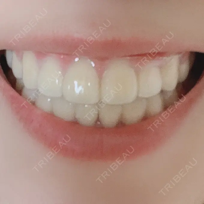 矯正（ワイヤー） ランバート矯正歯科 DAY 597 メイン用