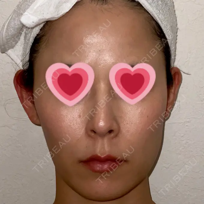 ボトックス（エラ・小顔） もとび美容外科クリニック 新宿院 AFTER メイン用