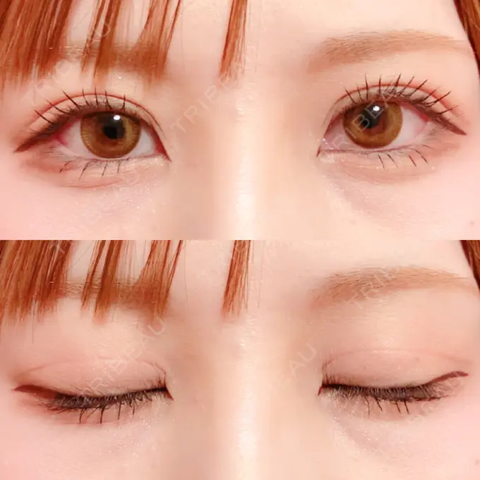 二重切開 / 上まぶたの脂肪取り / その他（目元） 銀座高須クリニック DAY 141 メイン用