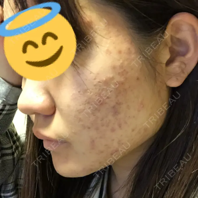 ピーリング（ニキビ・毛穴） / イオン導入 / エレクトロポレーション 湘南美容クリニック 宇都宮院 DAY 0 メイン用