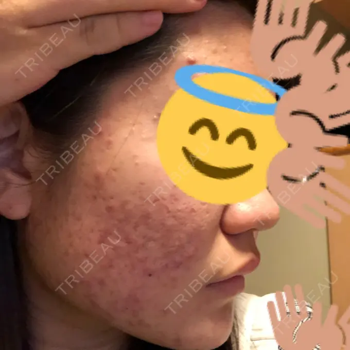 ピーリング（ニキビ・毛穴） / イオン導入 / エレクトロポレーション 湘南美容クリニック 宇都宮院 DAY 0 メイン用