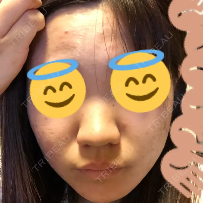 ピーリング（ニキビ・毛穴） / イオン導入 / エレクトロポレーション 湘南美容クリニック 宇都宮院 DAY 0 メイン用