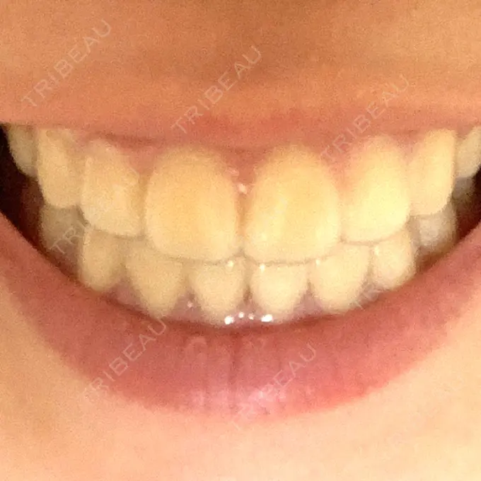 矯正（ワイヤー） ランバート矯正歯科 DAY 598 メイン用