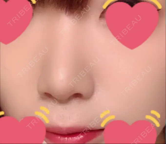 鼻尖形成（切開） / 小鼻縮小（切開） / 軟骨移植 もとび美容外科クリニック 新宿院 DAY 96 メイン用