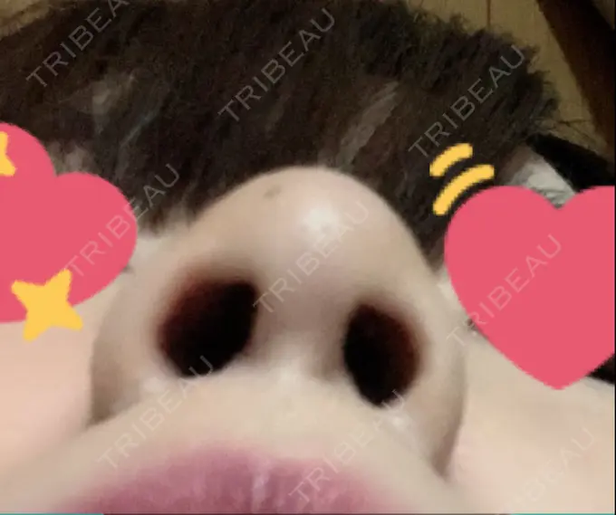 鼻尖形成（切開） / 小鼻縮小（切開） / 軟骨移植 もとび美容外科クリニック 新宿院 DAY 96 メイン用