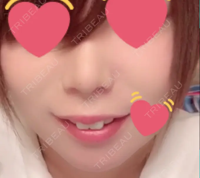 鼻尖形成（切開） / 小鼻縮小（切開） / 軟骨移植 もとび美容外科クリニック 新宿院 DAY 170 メイン用