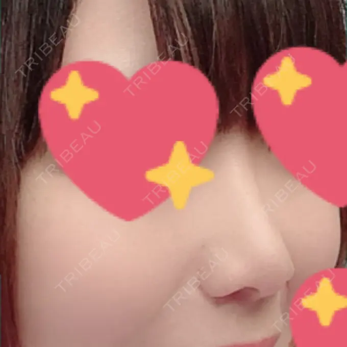 鼻尖形成（切開） / 小鼻縮小（切開） / 軟骨移植 もとび美容外科クリニック 新宿院 DAY 184 メイン用