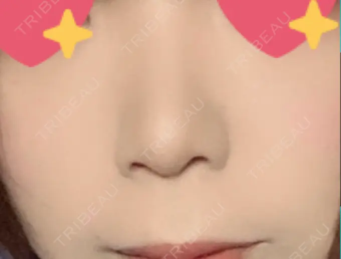 鼻尖形成（切開） / 小鼻縮小（切開） / 軟骨移植 もとび美容外科クリニック 新宿院 DAY 184 メイン用