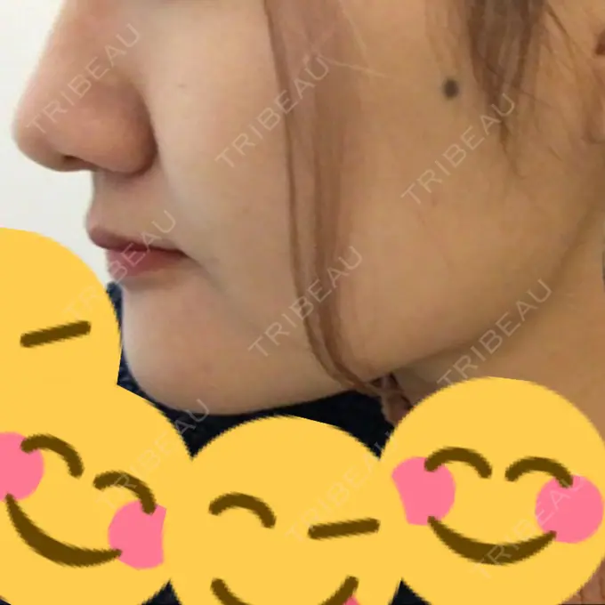 脂肪吸引（顔） アサミ美容外科 渋谷院 AFTER メイン用