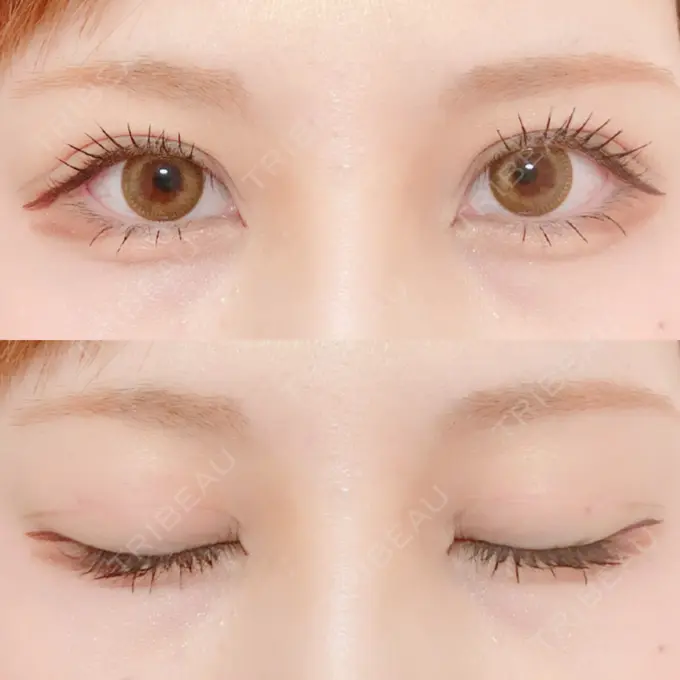 二重切開 / 上まぶたの脂肪取り / その他（目元） 銀座高須クリニック DAY 144 メイン用